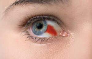 Derrame ocular: causas e como tratar