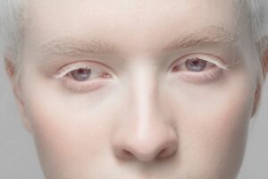 Como o albinismo afeta os olhos?