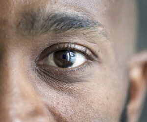 Descolamento de retina: causas, sintomas e tratamentos